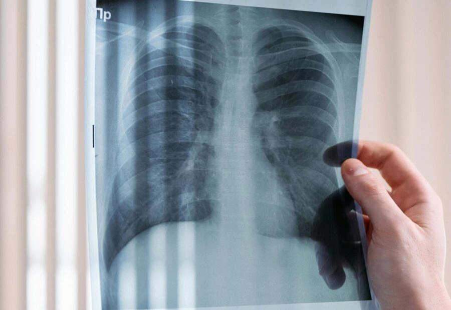 Što je legionarska bolest? Evo koji su simptomi i kako se liječi